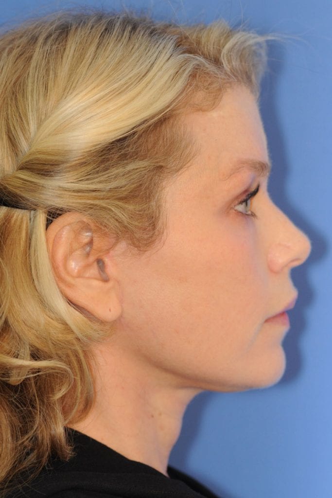 vertical-facelift-01 After - 4