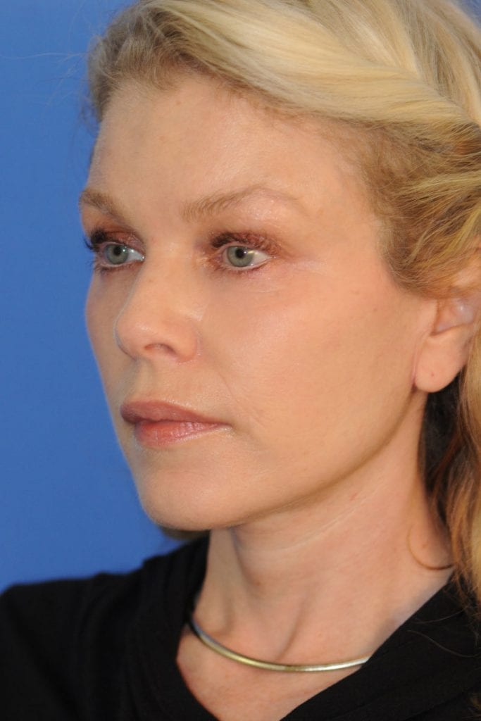 facelift-patient-06 After - 3