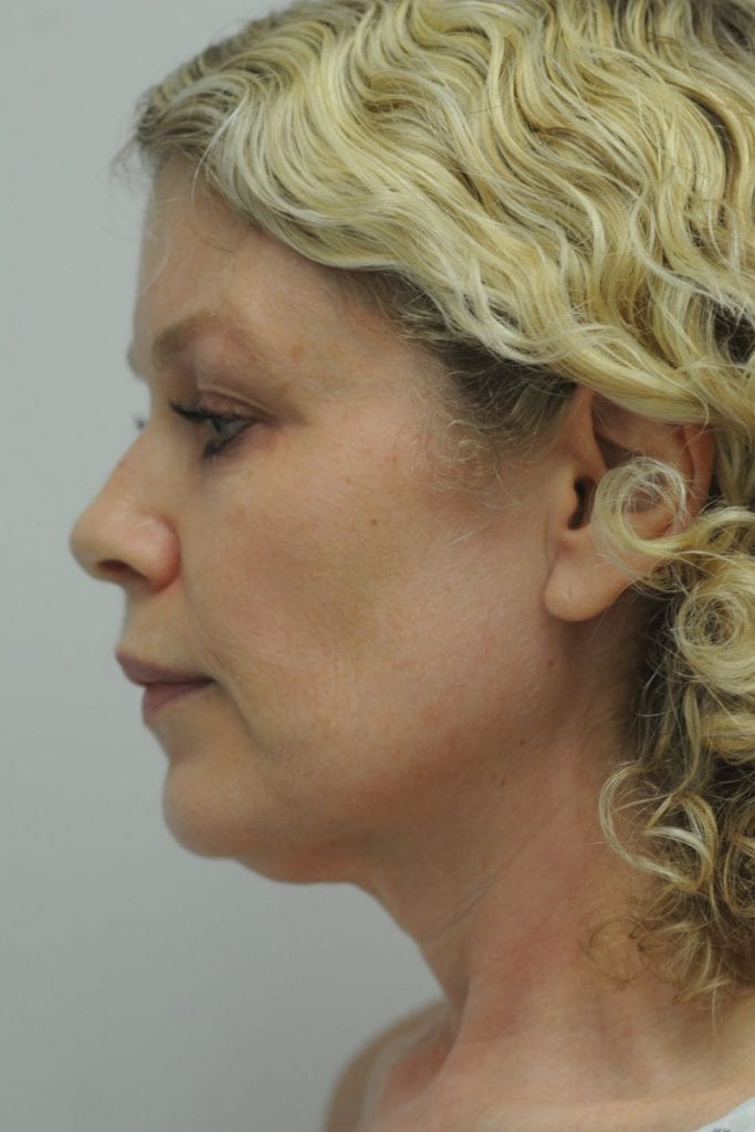 Facelift Patient 01 Before - 2